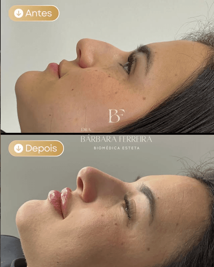 Rinomodelação - Dra. Bárbara Ferreira, Biomédica Esteta