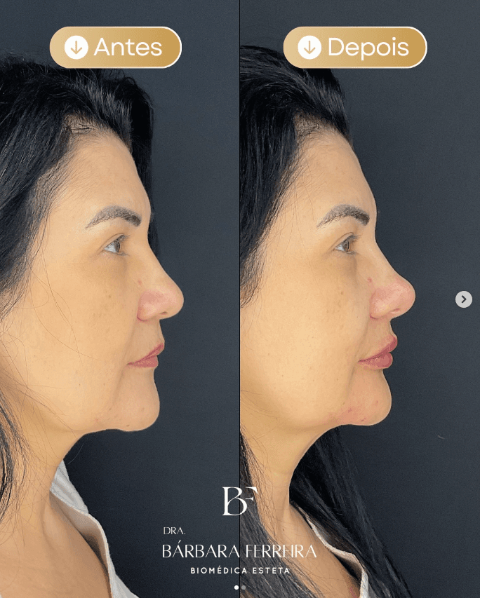 Rinomodelação - Dra. Bárbara Ferreira, Biomédica Esteta