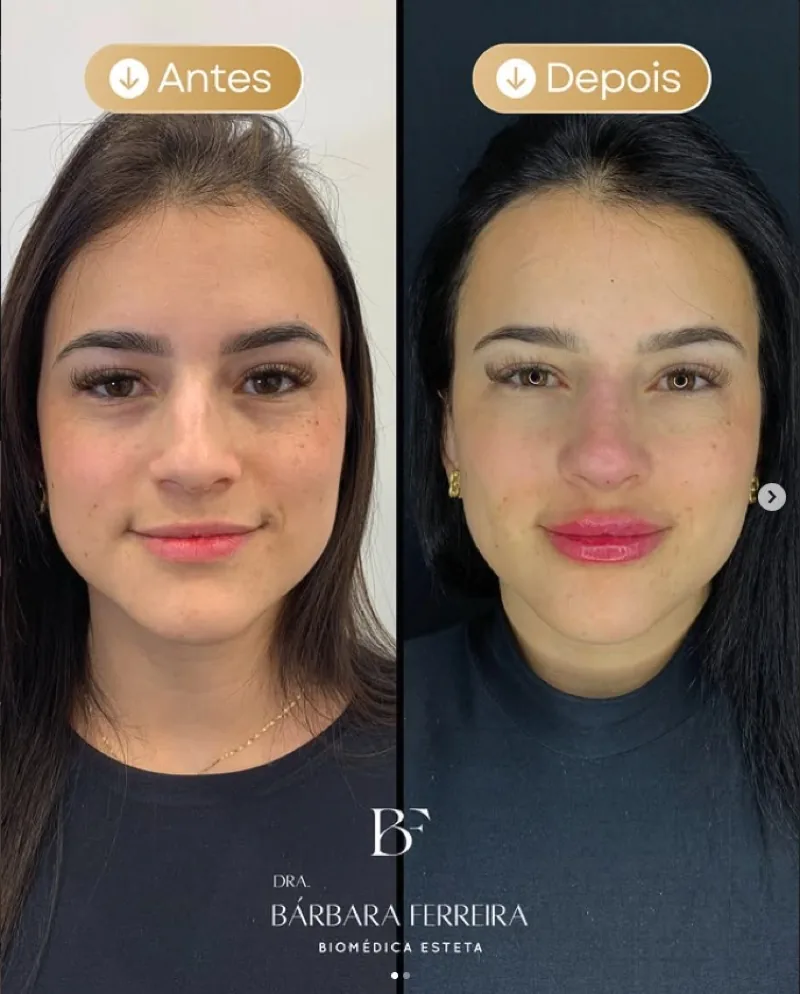 Resultado de preenchimento labial — antes e depois