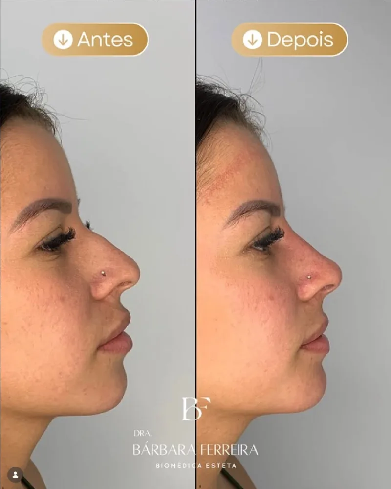 Resultado de rinomodelação — antes e depois