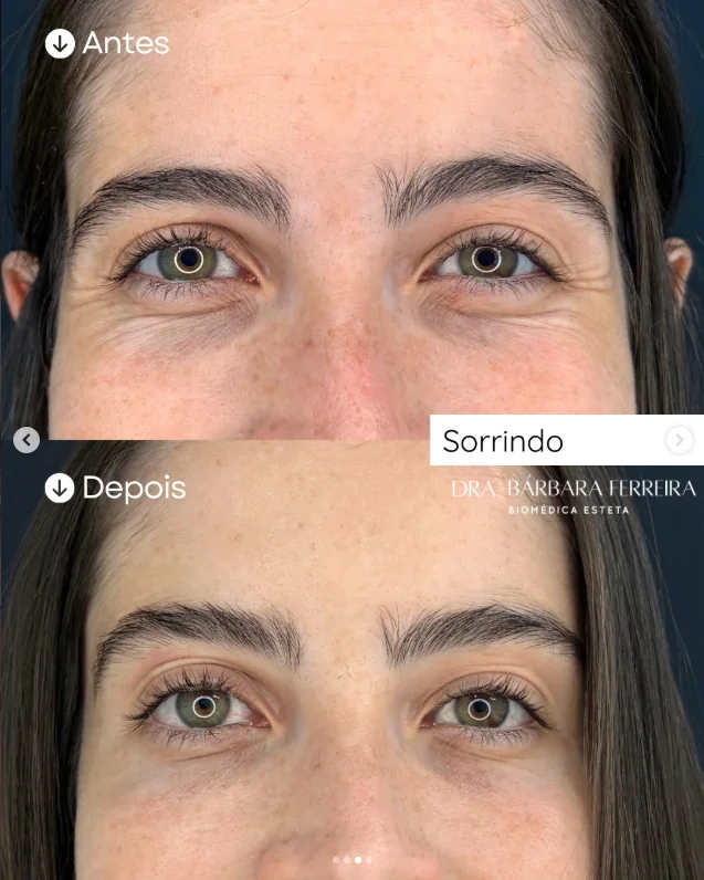 Resultado de toxina botulínica na região dos olhos — antes e depois