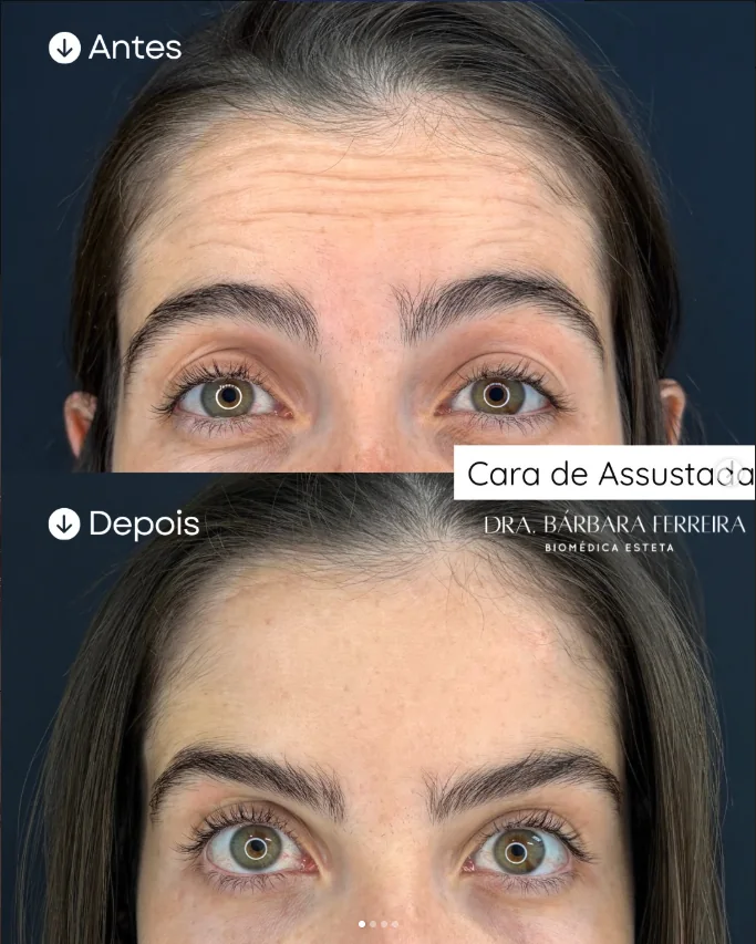 Resultado de toxina botulínica na testa — antes e depois