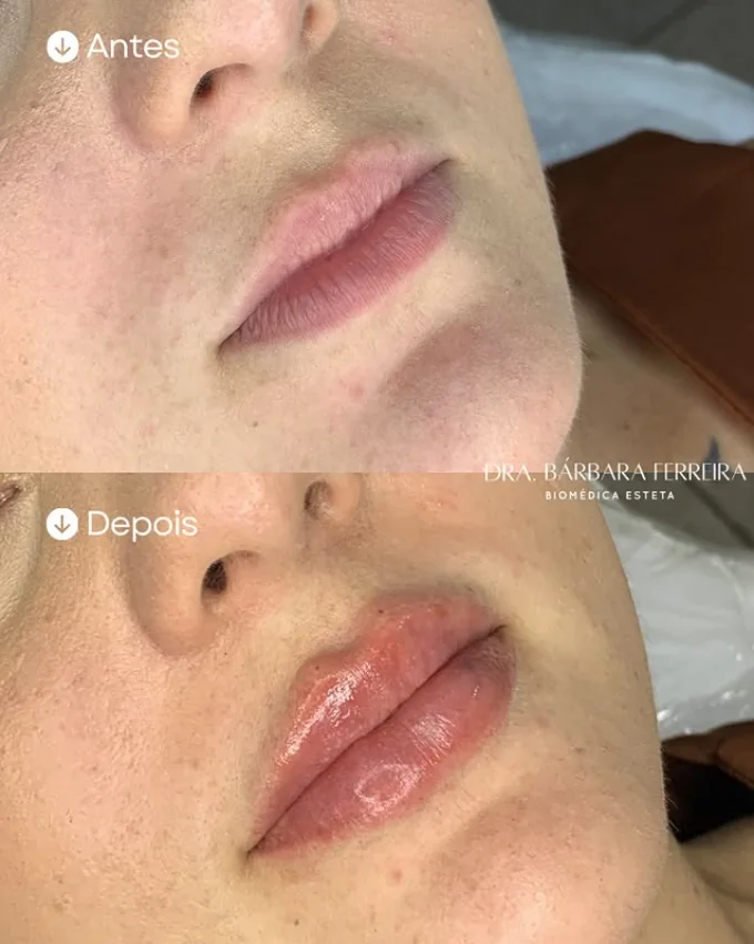 Resultado de preenchimento labial — antes e depois