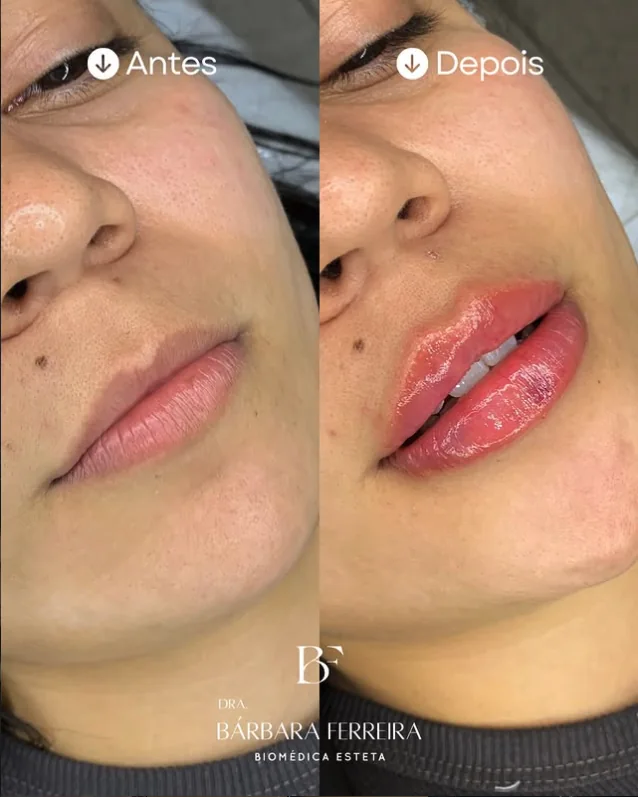 Resultado de preenchimento labial — antes e depois