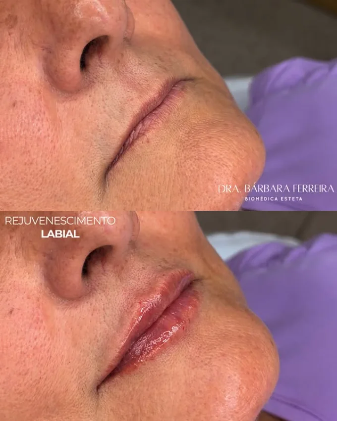Resultado de rejuvenescimento labial — antes e depois