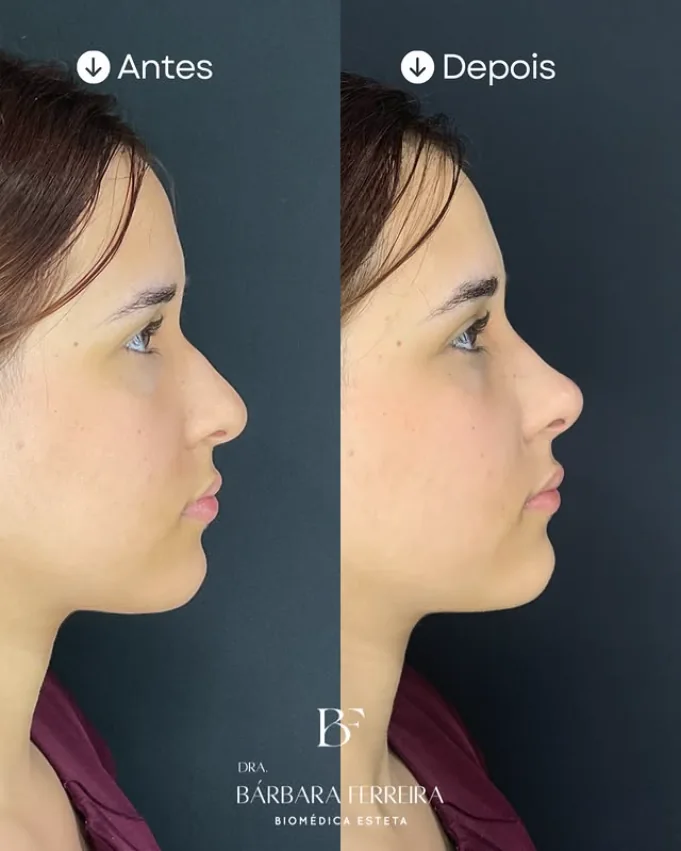 Resultado de rinomodelação — antes e depois